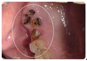拔蛀牙视频全过程成人,成人视角下的牙科手术全过程揭秘